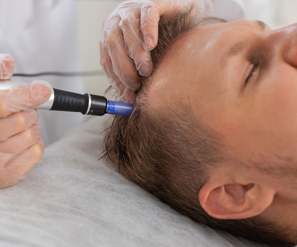 Practitioner using a microneedling pen on a patient's hairline