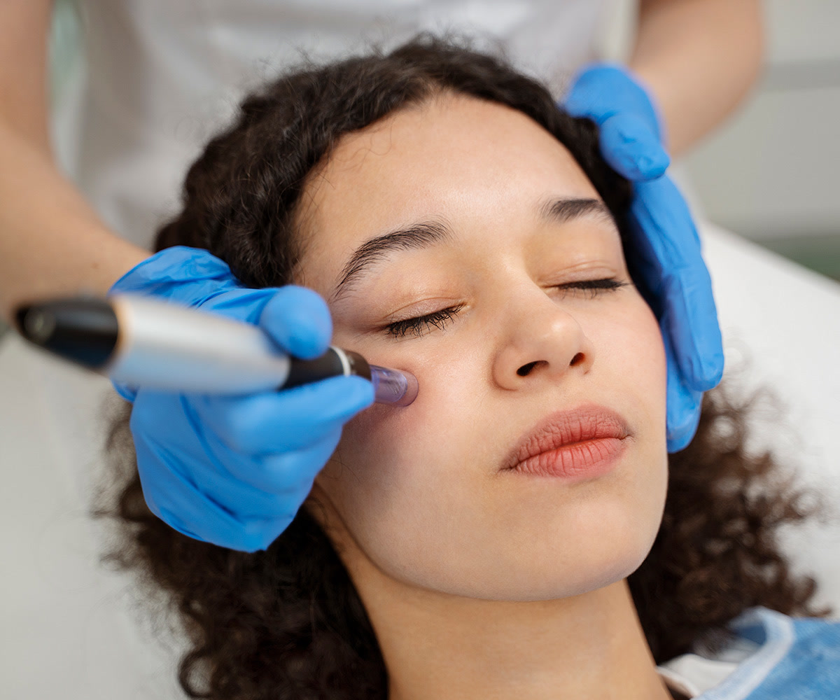 Practitioner applying a handheld microneedling device to a woman's cheek